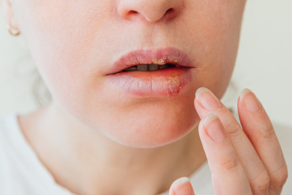 Die listige Bedrohung der Herpesviren